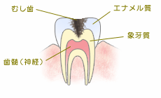 虫歯の構造