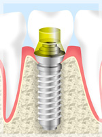 インプラント治療